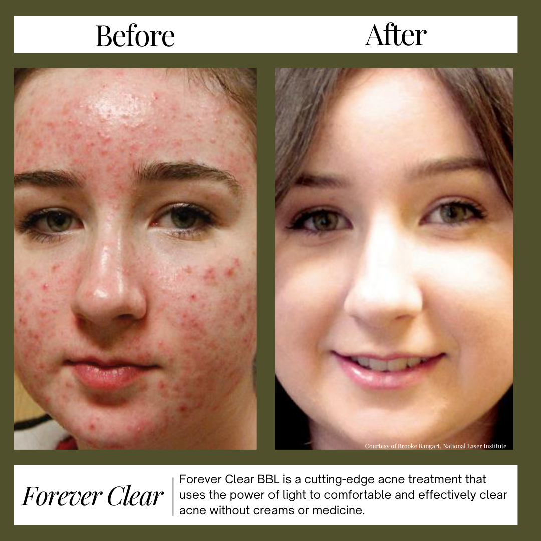 Before and After Forever Clear