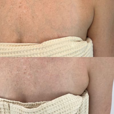 Kybella Before & After Gallery - Patient 337019 - Image 2