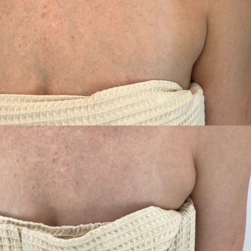 Kybella Before & After Gallery - Patient 337019 - Image 2
