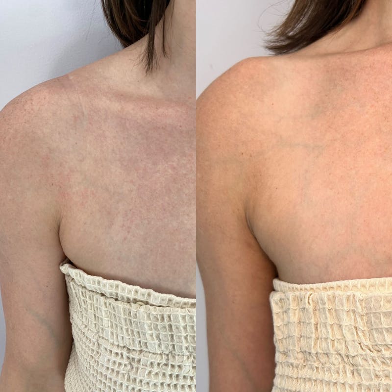 Kybella Before & After Gallery - Patient 337019 - Image 1