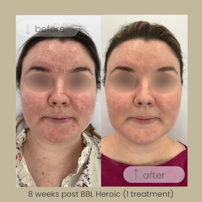 BBL Before & After Gallery - Patient 188793 - Image 1