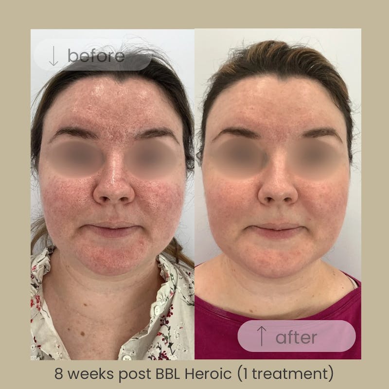 BBL Before & After Gallery - Patient 188793 - Image 1