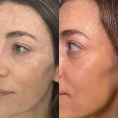 MOXI Before & After Gallery - Patient 228248 - Image 1