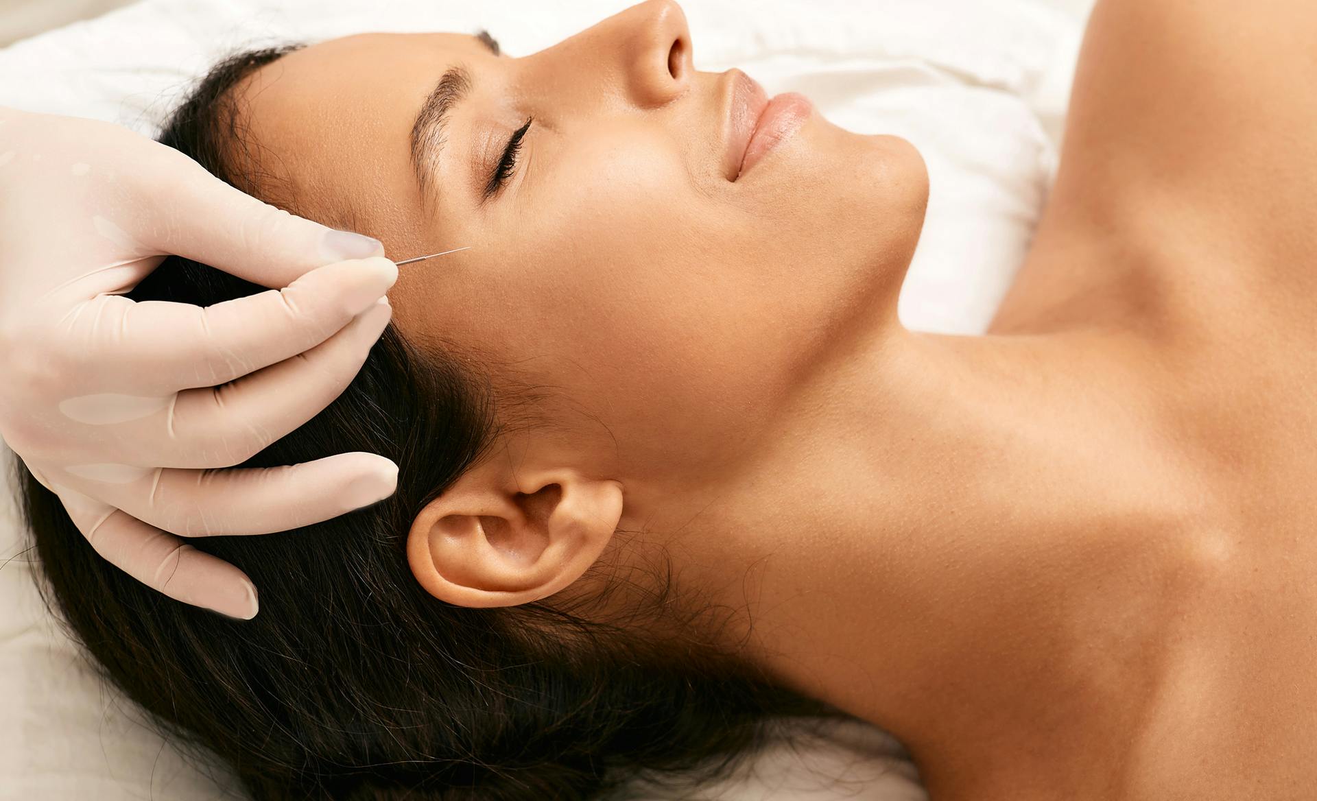 woman receiving acupuncture treatment