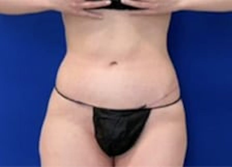 Drainless Tummy Tuck Before & After Gallery - Patient 399417 - Image 2