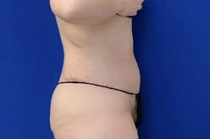 Drainless Tummy Tuck Before & After Gallery - Patient 399417 - Image 6