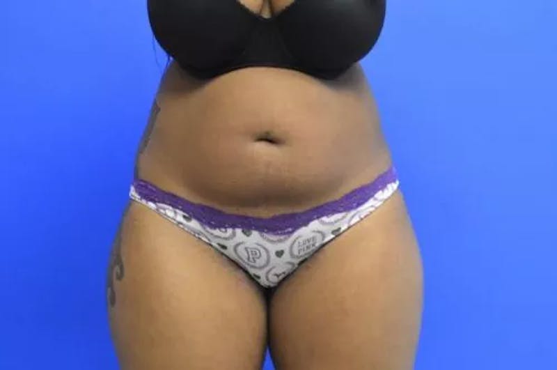 Liposuction Before & After Gallery - Patient 331613 - Image 1