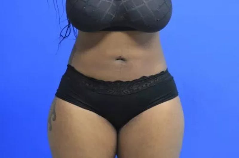 Liposuction Before & After Gallery - Patient 331613 - Image 2