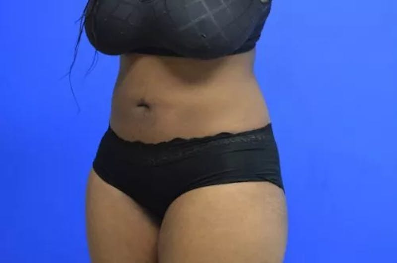 Liposuction Before & After Gallery - Patient 331613 - Image 4