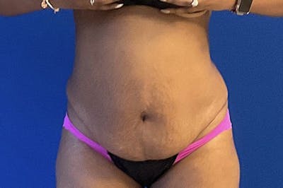 Drainless Tummy Tuck Before & After Gallery - Patient 382201 - Image 1