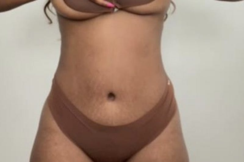 Drainless Tummy Tuck Before & After Gallery - Patient 382201 - Image 2