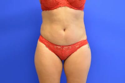Liposuction Before & After Gallery - Patient 398887 - Image 1