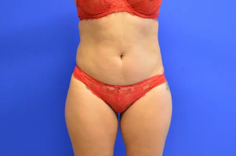 Liposuction Before & After Gallery - Patient 398887 - Image 1