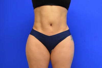 Liposuction Before & After Gallery - Patient 398887 - Image 2