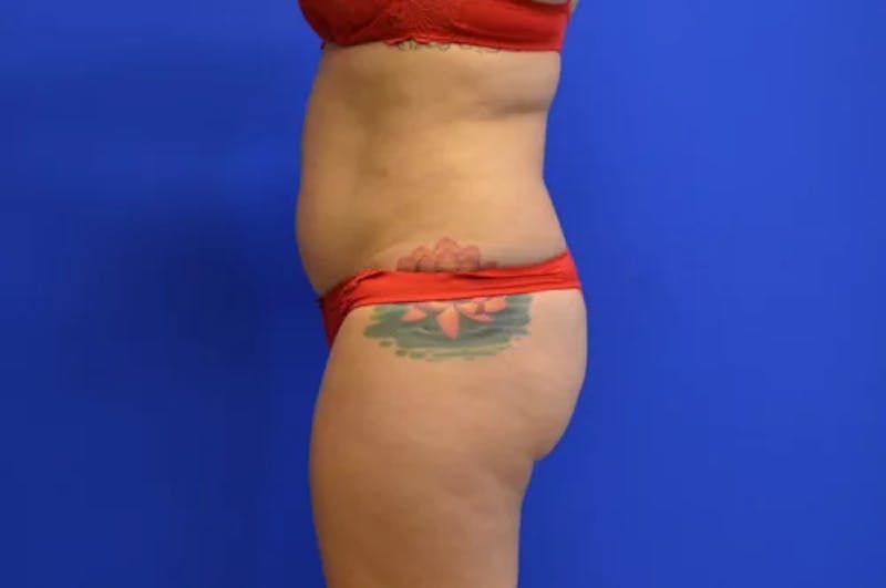 Liposuction Before & After Gallery - Patient 398887 - Image 3
