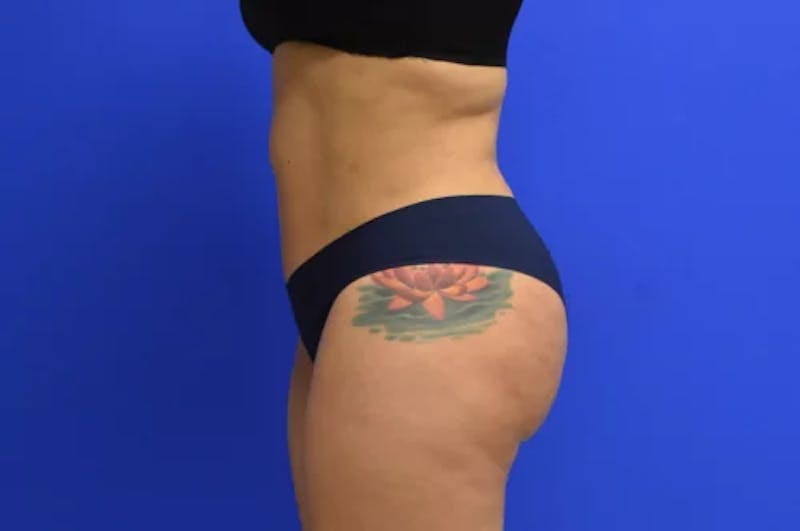 Liposuction Before & After Gallery - Patient 398887 - Image 4