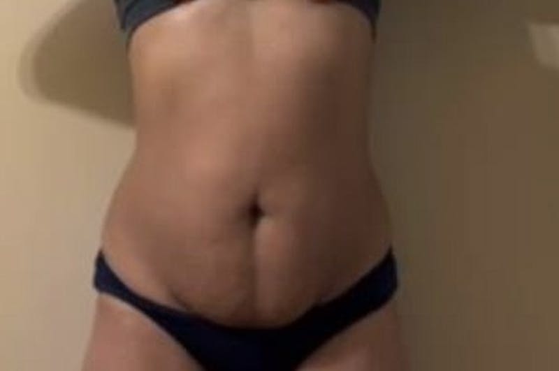 Drainless Tummy Tuck Before & After Gallery - Patient 441262 - Image 1