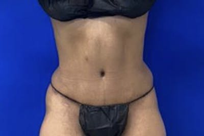 Drainless Tummy Tuck Before & After Gallery - Patient 441262 - Image 2