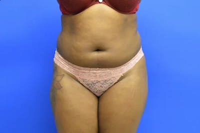 Liposuction Before & After Gallery - Patient 277198 - Image 1