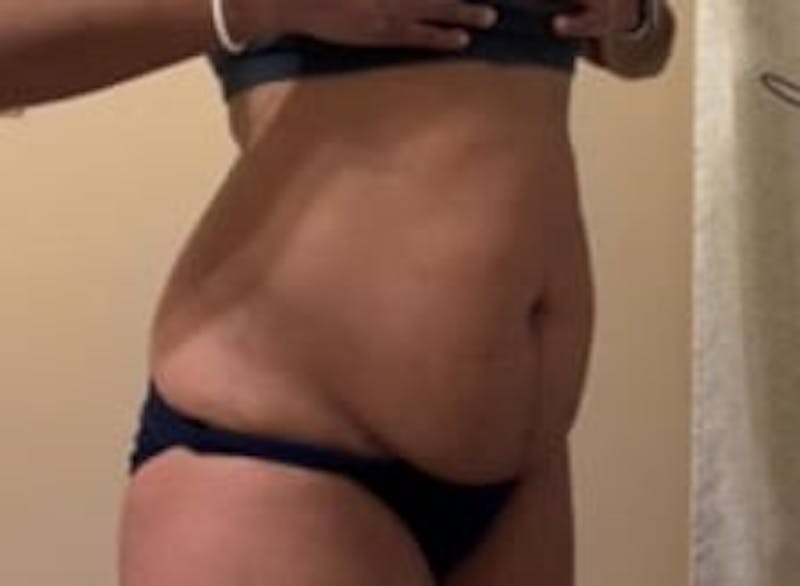 Drainless Tummy Tuck Before & After Gallery - Patient 441262 - Image 3