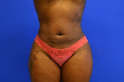 Liposuction Before & After Gallery - Patient 277198 - Image 2
