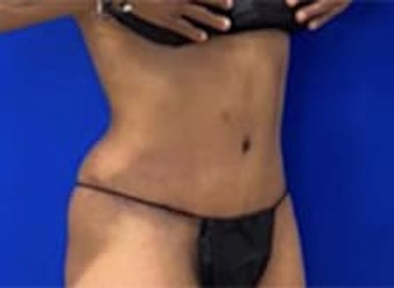 Drainless Tummy Tuck Before & After Gallery - Patient 441262 - Image 4