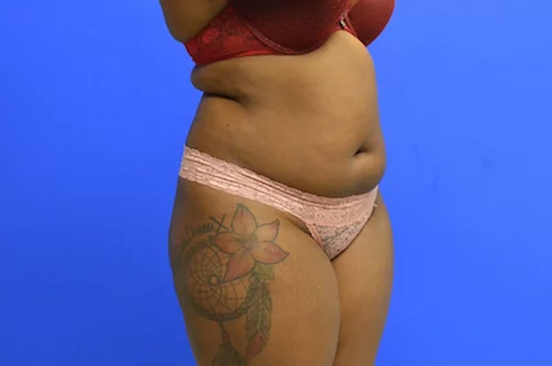 Liposuction Before & After Gallery - Patient 277198 - Image 3