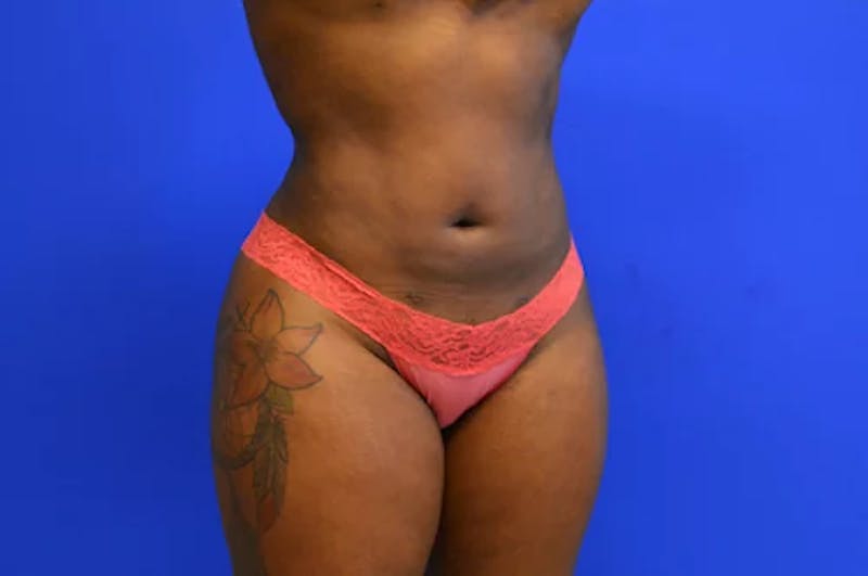 Liposuction Before & After Gallery - Patient 277198 - Image 4