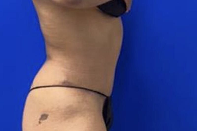 Drainless Tummy Tuck Before & After Gallery - Patient 441262 - Image 6