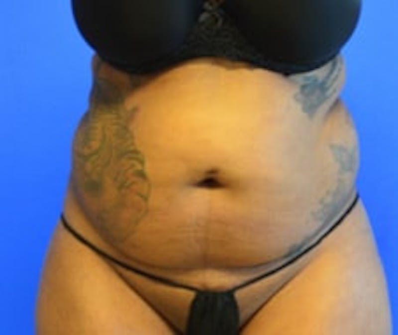 Drainless Tummy Tuck Before & After Gallery - Patient 222033 - Image 1
