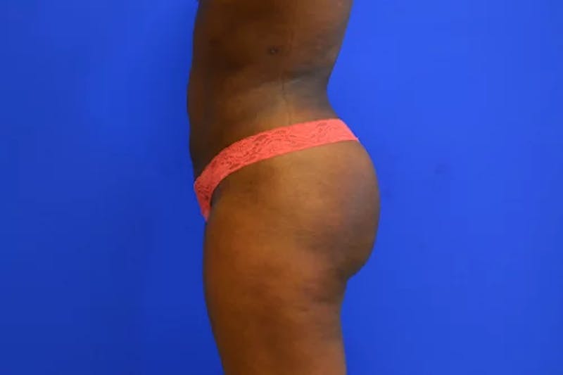 Liposuction Before & After Gallery - Patient 277198 - Image 6