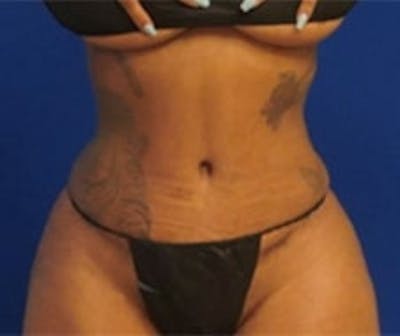 Drainless Tummy Tuck Before & After Gallery - Patient 222033 - Image 2