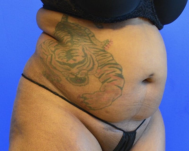 Drainless Tummy Tuck Before & After Gallery - Patient 222033 - Image 3