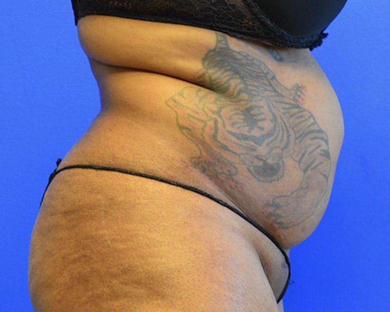 Drainless Tummy Tuck Before & After Gallery - Patient 222033 - Image 5