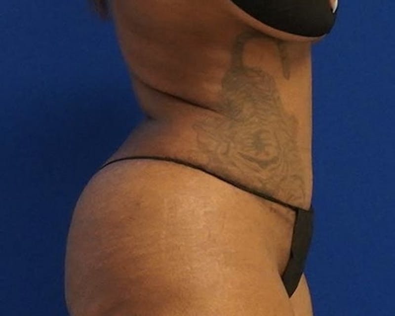 Drainless Tummy Tuck Before & After Gallery - Patient 222033 - Image 6