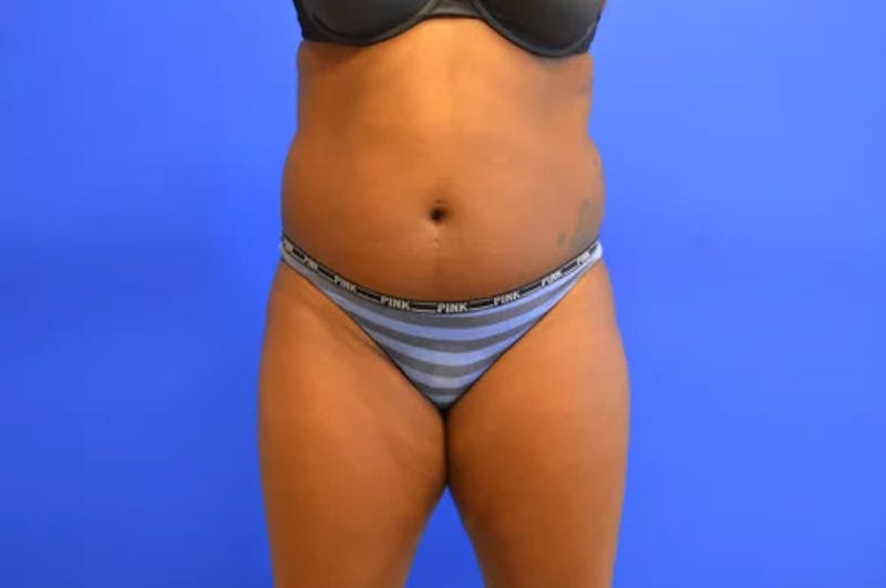 Liposuction Before & After Gallery - Patient 367196 - Image 1