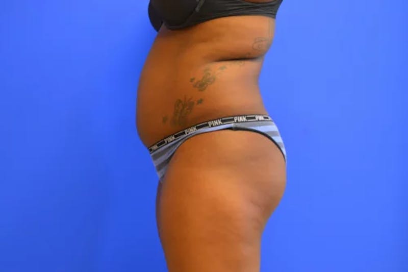 Liposuction Before & After Gallery - Patient 367196 - Image 5