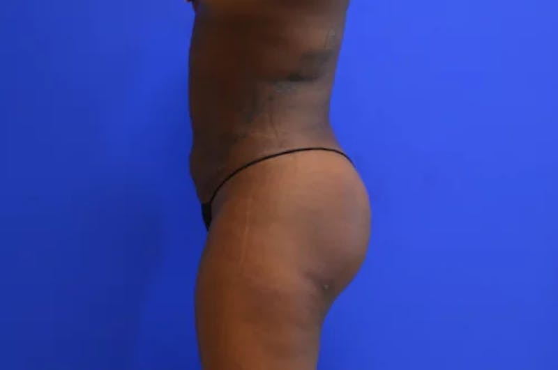 Liposuction Before & After Gallery - Patient 367196 - Image 6
