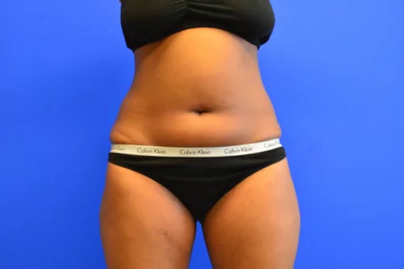 Liposuction Before & After Gallery - Patient 154670 - Image 1