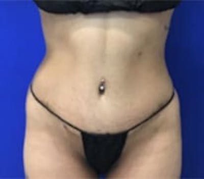Drainless Tummy Tuck Before & After Gallery - Patient 727785 - Image 2