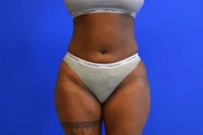 Liposuction Before & After Gallery - Patient 154670 - Image 2