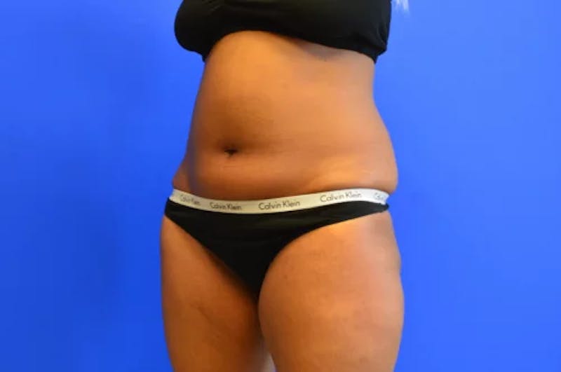 Liposuction Before & After Gallery - Patient 154670 - Image 3