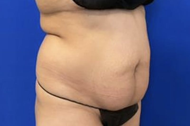Drainless Tummy Tuck Before & After Gallery - Patient 727785 - Image 3