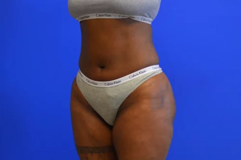 Liposuction Before & After Gallery - Patient 154670 - Image 4