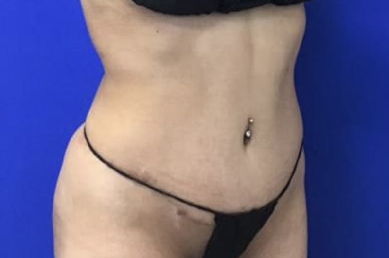 Drainless Tummy Tuck Before & After Gallery - Patient 727785 - Image 4
