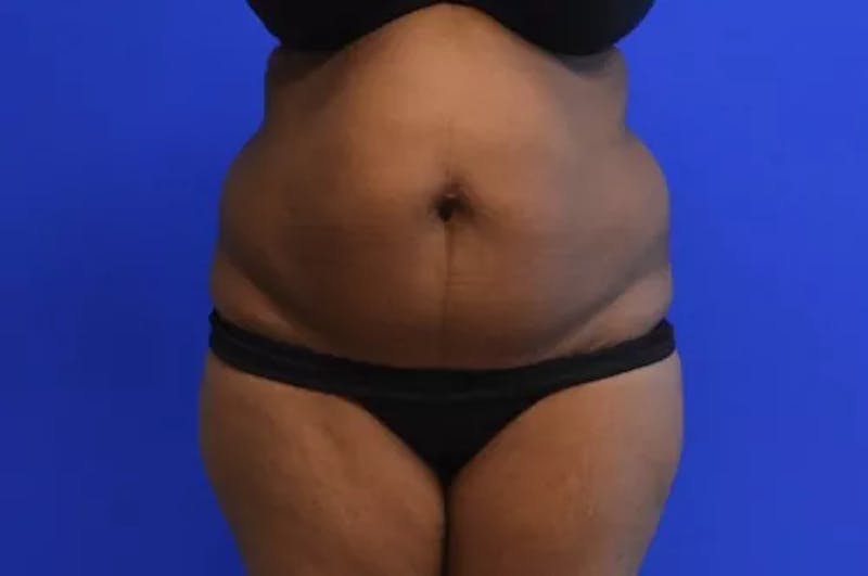 Liposuction Before & After Gallery - Patient 360615 - Image 1