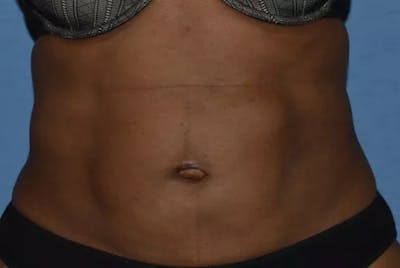 Abdominal Etching Before & After Gallery - Patient 858712 - Image 2