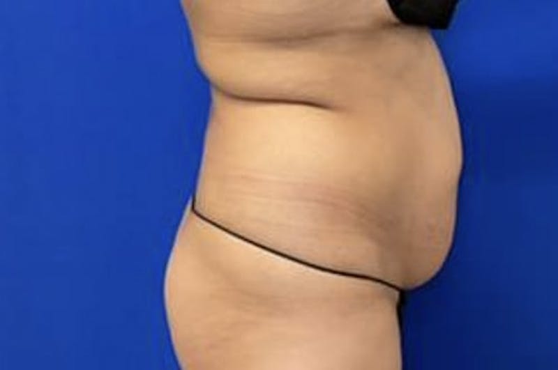 Drainless Tummy Tuck Before & After Gallery - Patient 727785 - Image 5