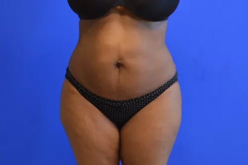 Liposuction Before & After Gallery - Patient 360615 - Image 2