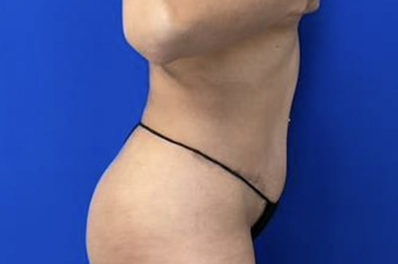 Drainless Tummy Tuck Before & After Gallery - Patient 727785 - Image 6
